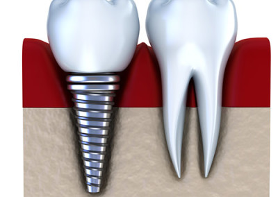 Was ist ein Implantat?